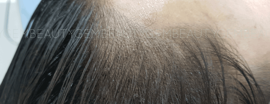 부평 헤어라인반영구 잘하는 곳2