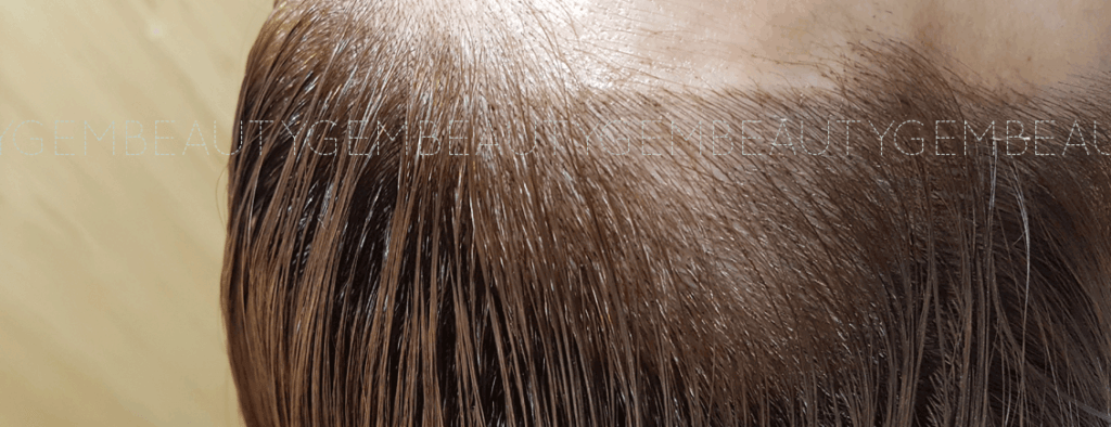 부평 헤어라인 반영구 잘하는 곳2