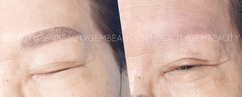 부평 부천 반영구